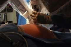 Virtually Scarless Laparoscopic Gallbladder Surgery