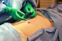 da Vinci Gallbladder Surgery