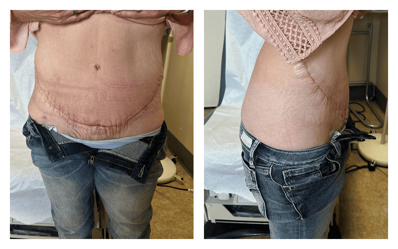 Before & After Tummy Tuck/Panniculectomy Photos - Nevada Surgical