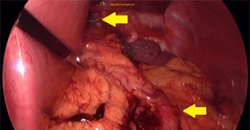 Reno Laparoscopic Sleeve Gastrectomy