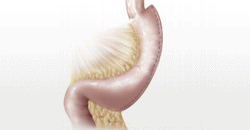 Gastric Sleeve Procedure Reno